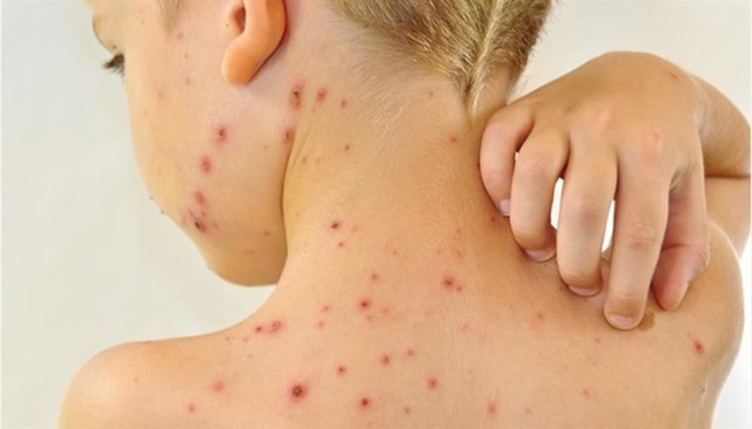 Lo streptococco è all'origine della scarlattina Lo streptococco è all'origine della scarlattina